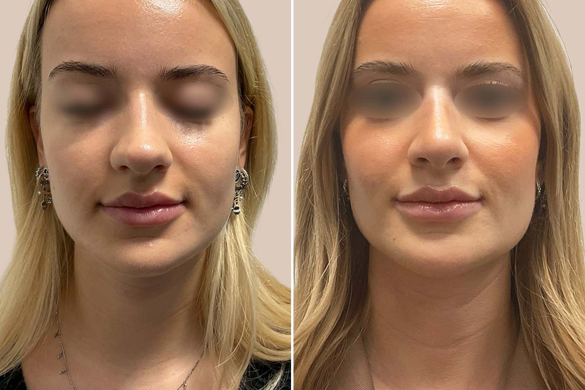 Kosmetisk næseoperation før og efter