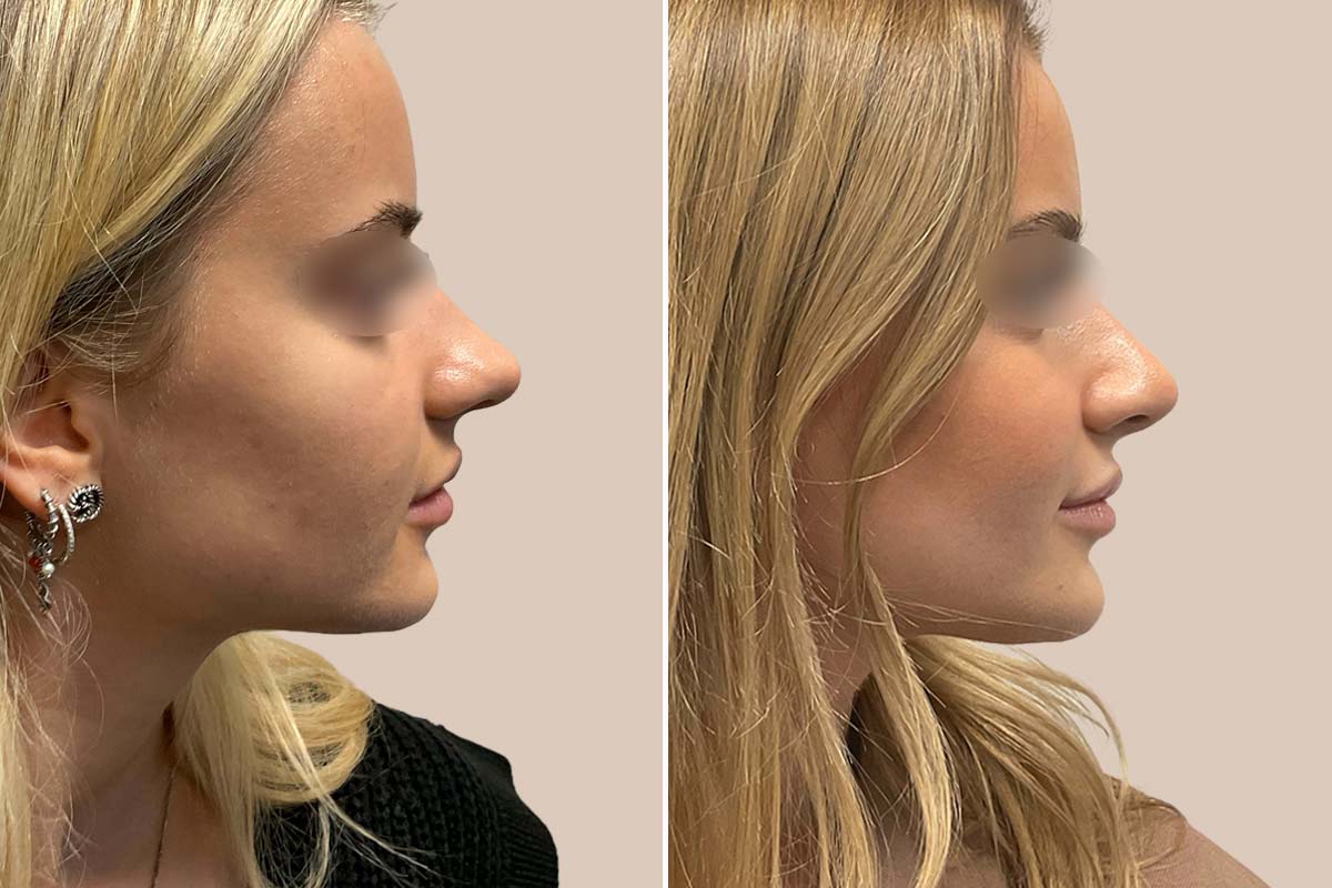 Kosmetisk næseoperation før og efter