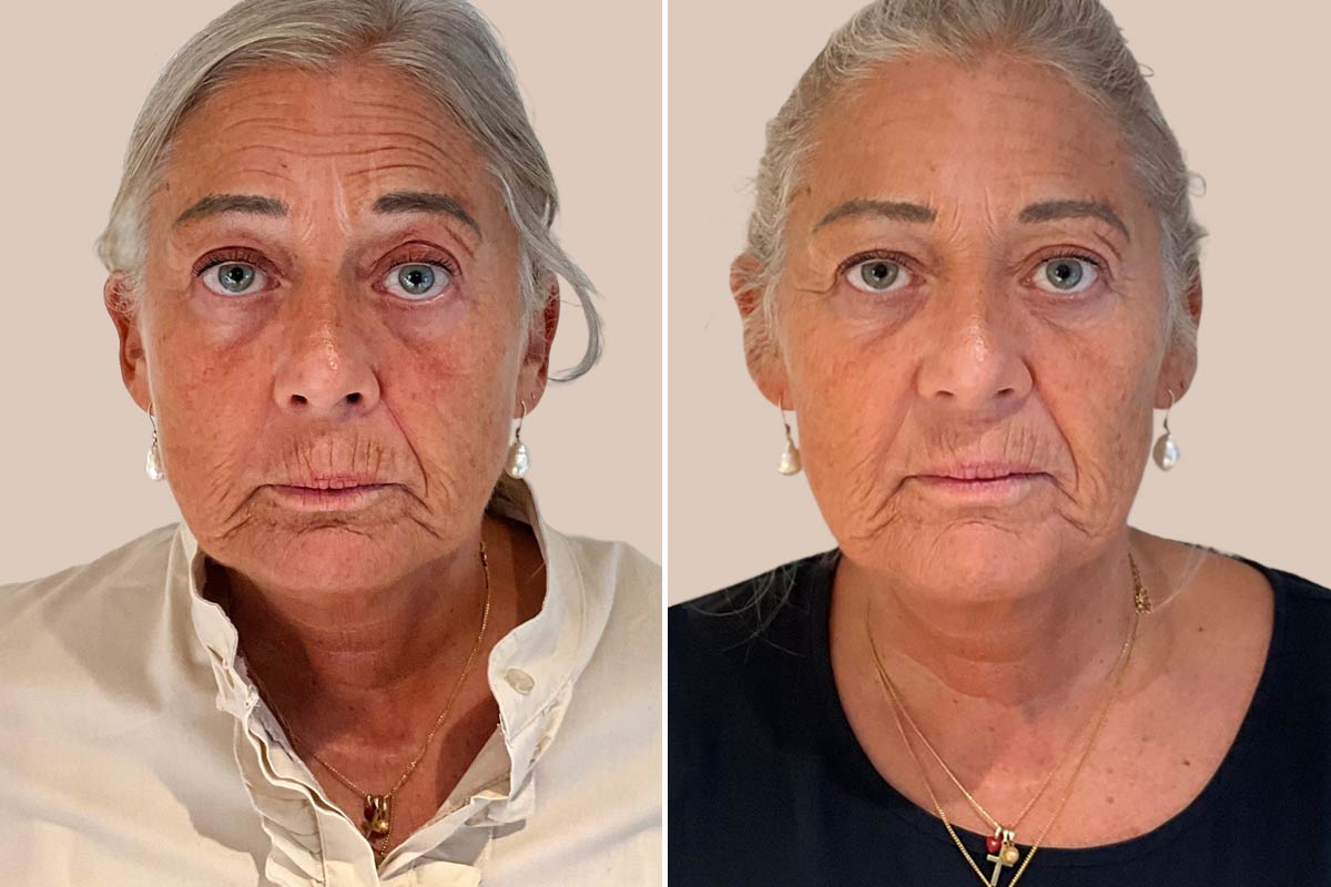 Skincare før og efter