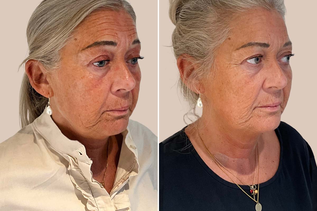 Skincare før og efter