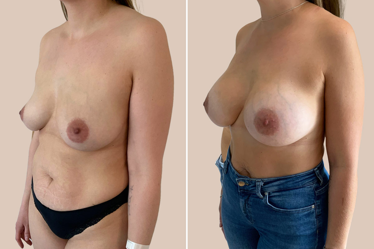 Brystforstørrelse før efter