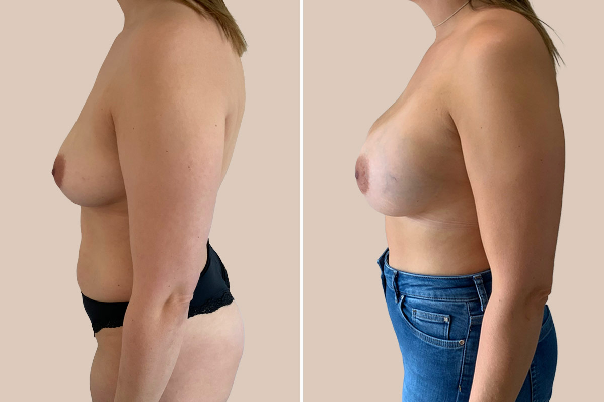 Brystforstørrelse før efter