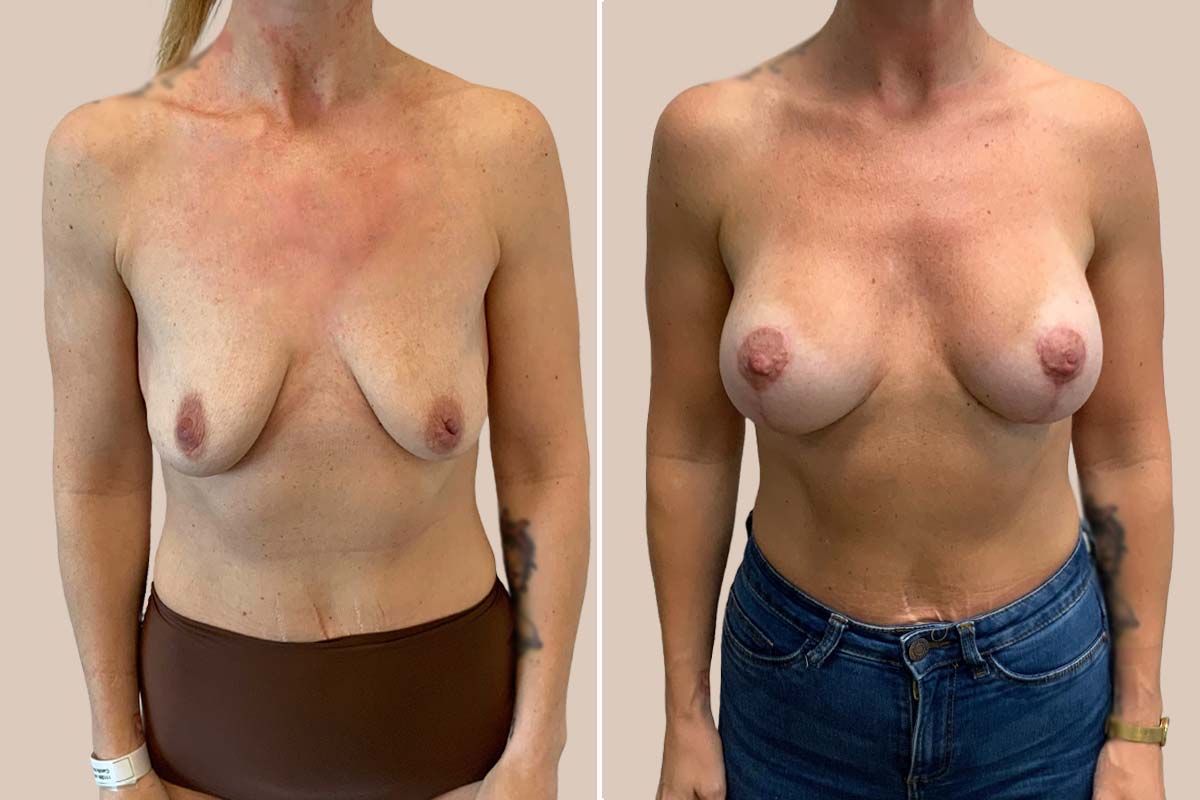 BFO og løft før og efter