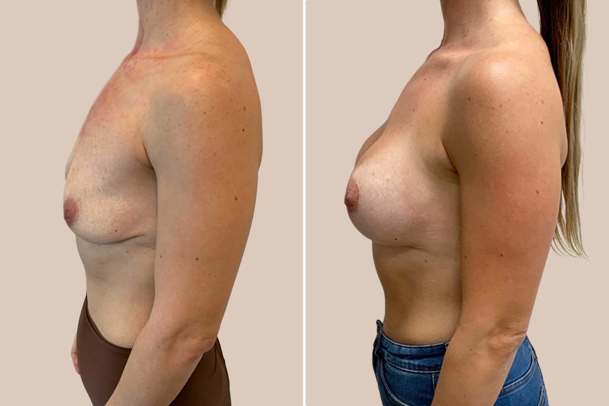 BFO og løft før og efter