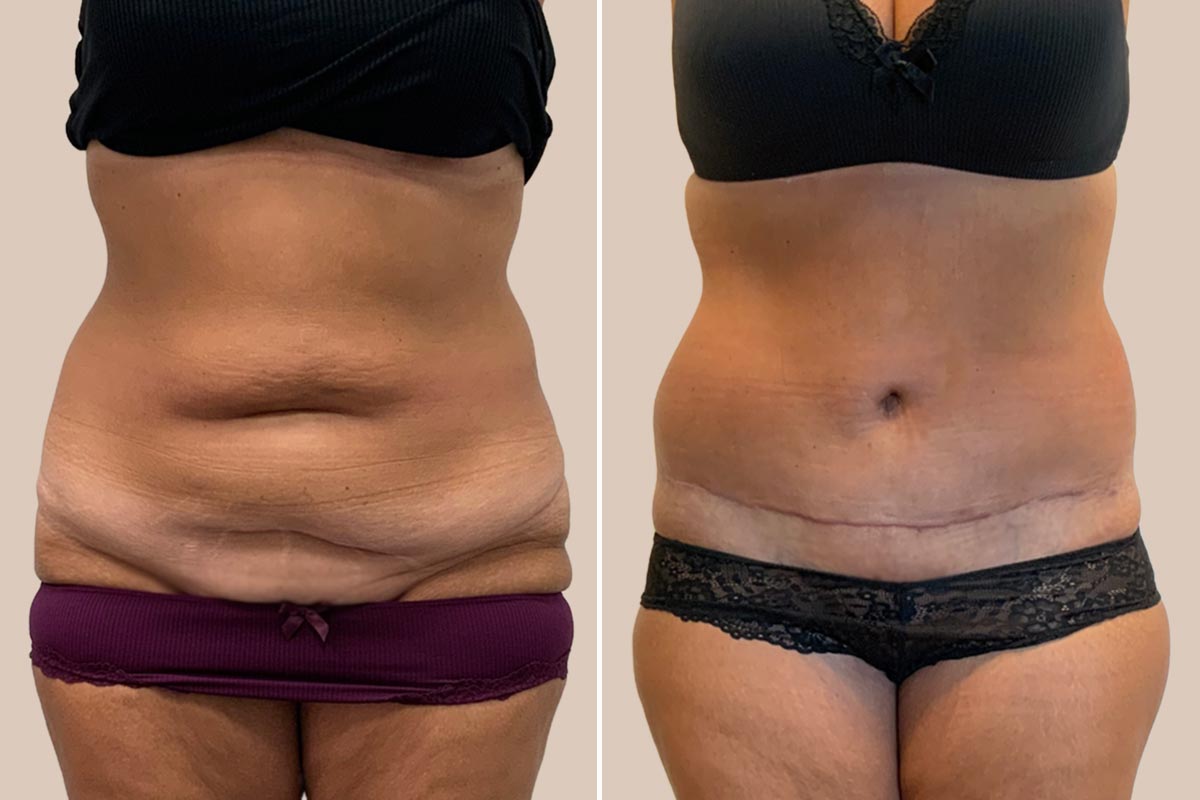 Stor maveplastik før og efter