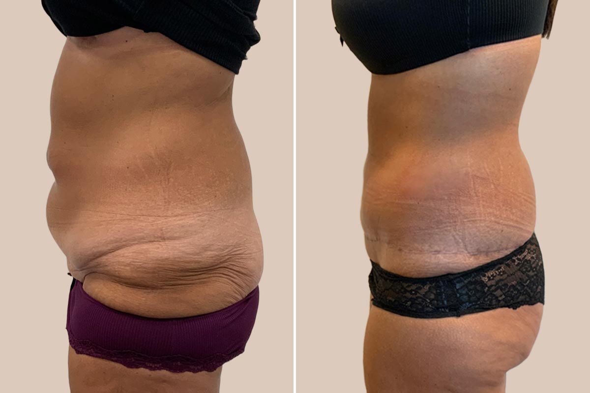 Stor maveplastik før og efter