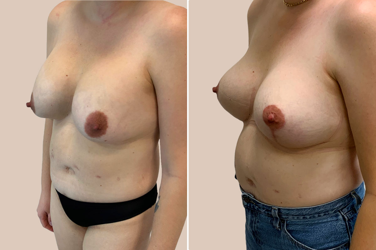 Udskiftning af implantater før og efter