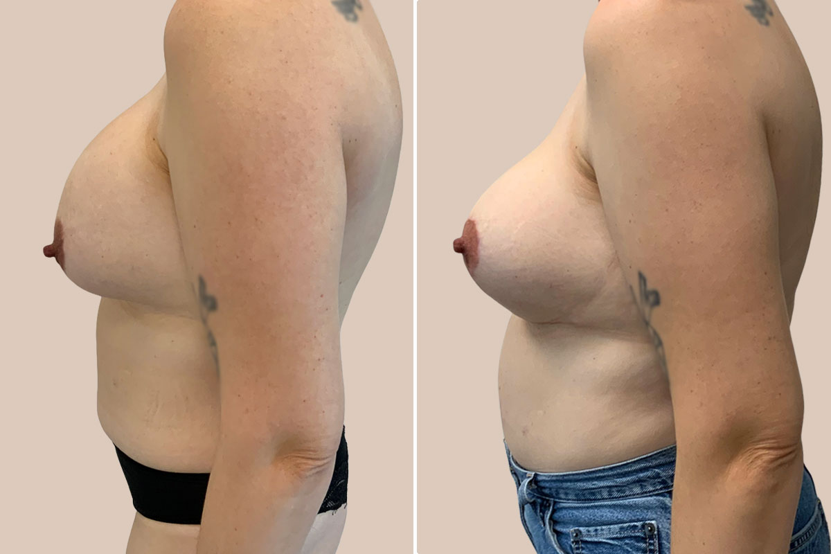 Udskiftning af implantater før og efter