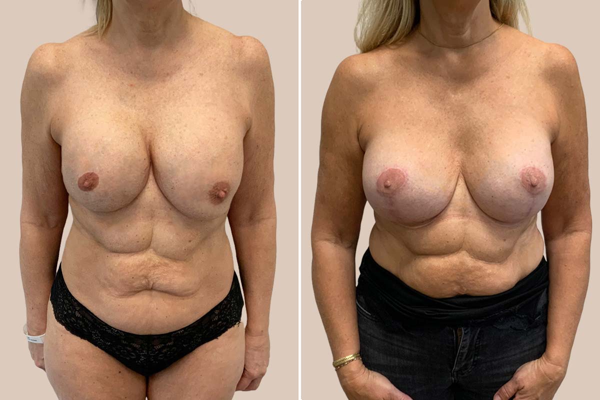 Udskiftning af implantater før og efter