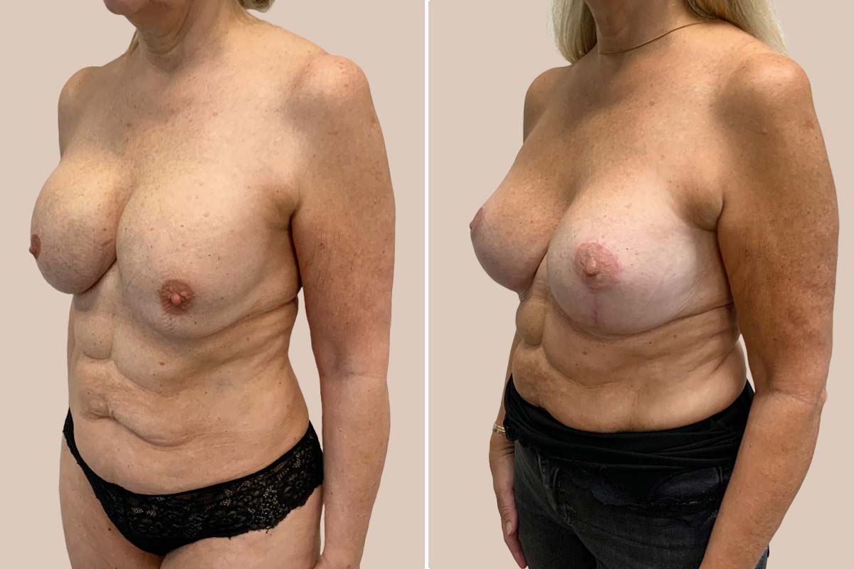 Udskiftning af implantater før og efter