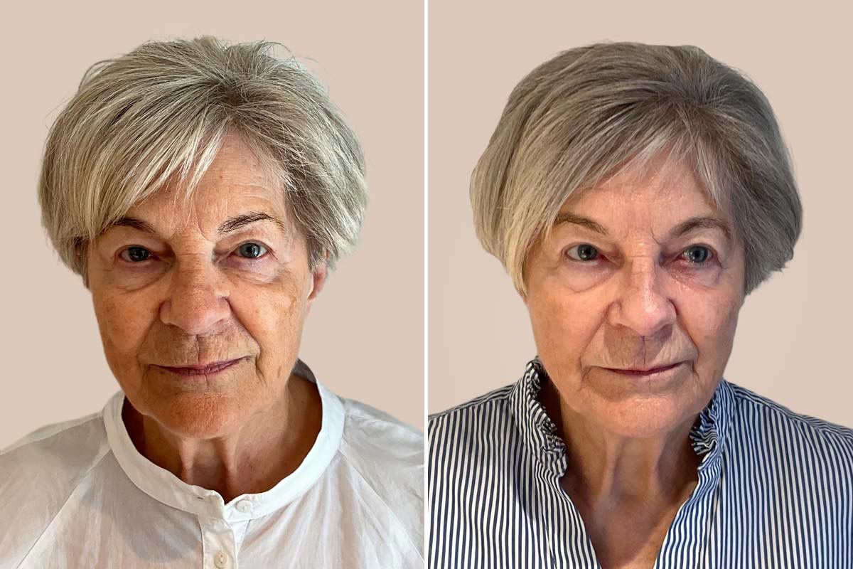 ADVATx laser før og efter