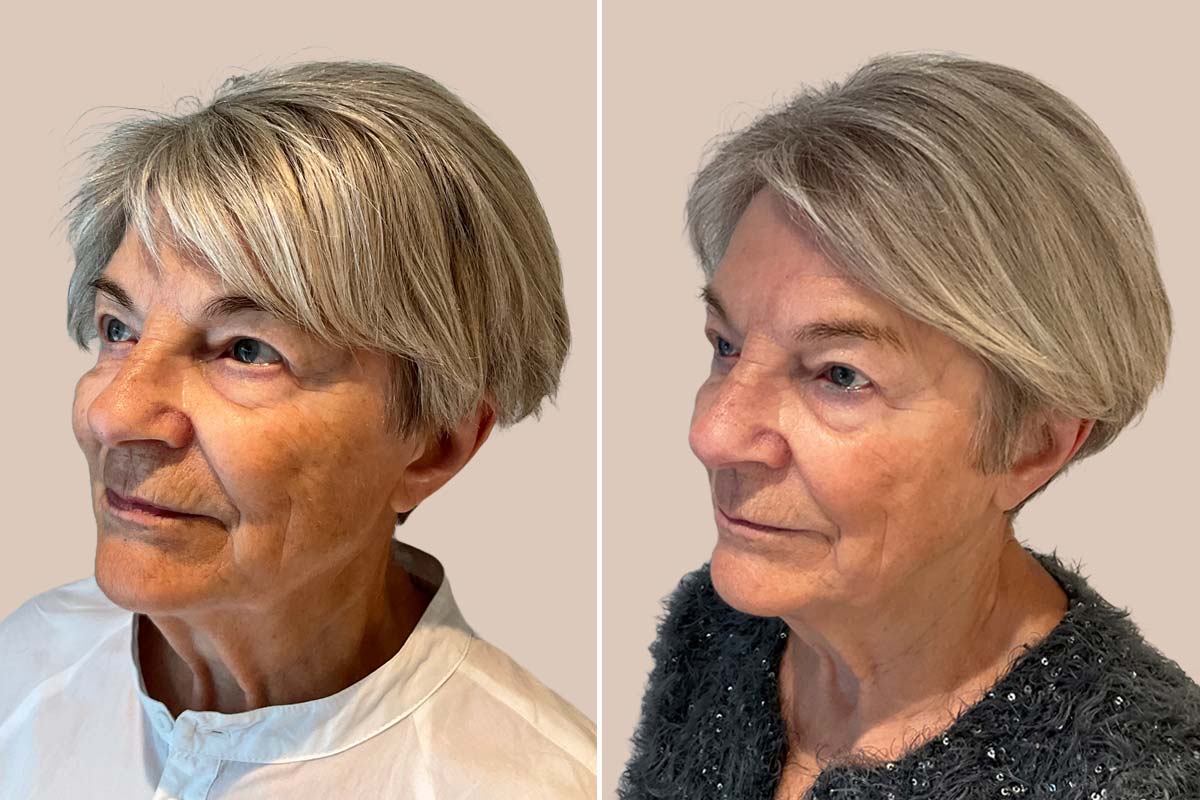 ADVATx laser før og efter