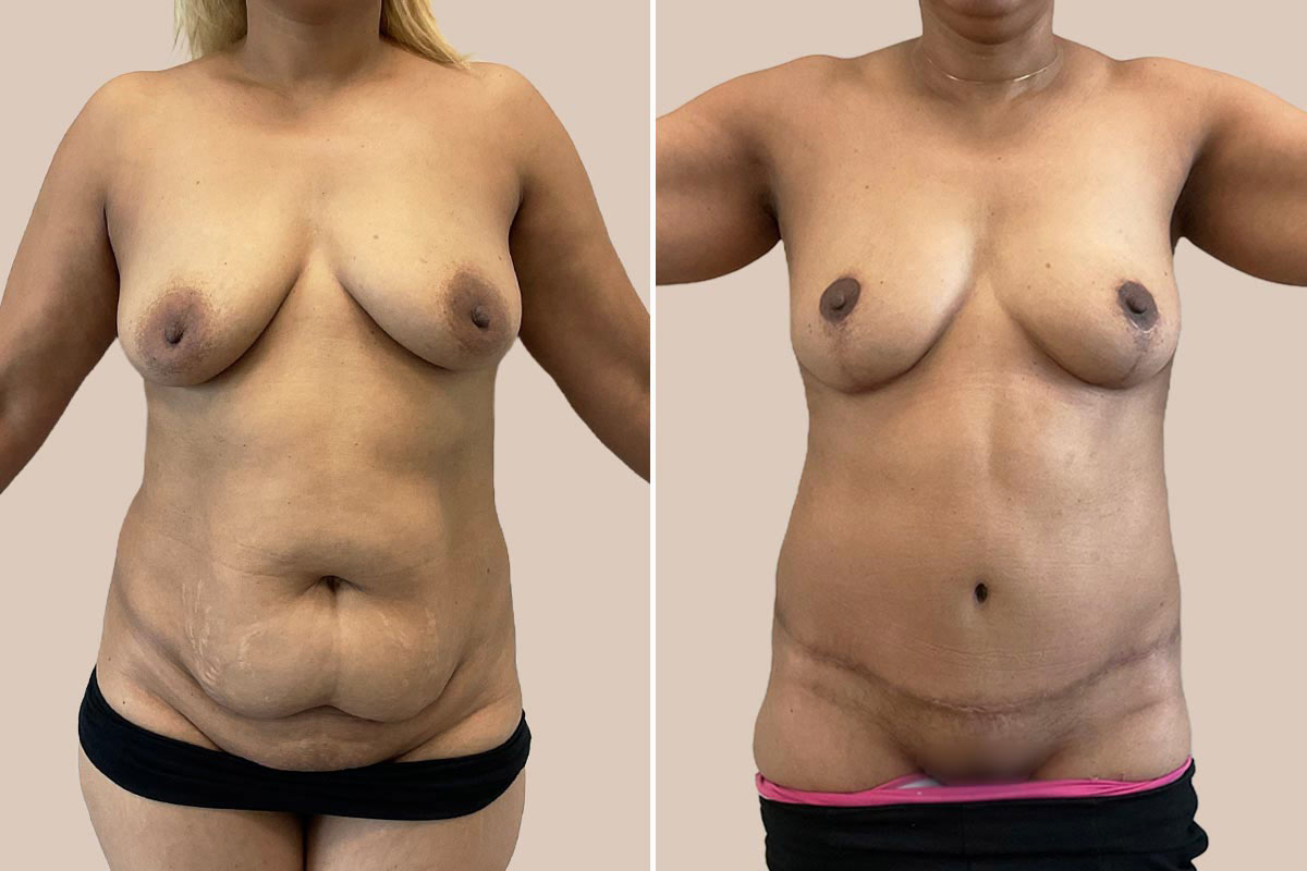 Mommy makeover før og efter