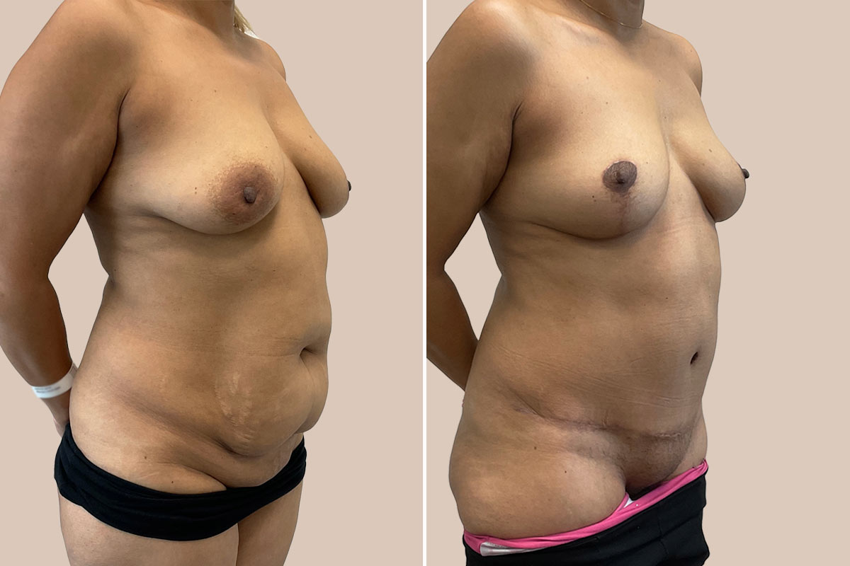 Mommy makeover før og efter