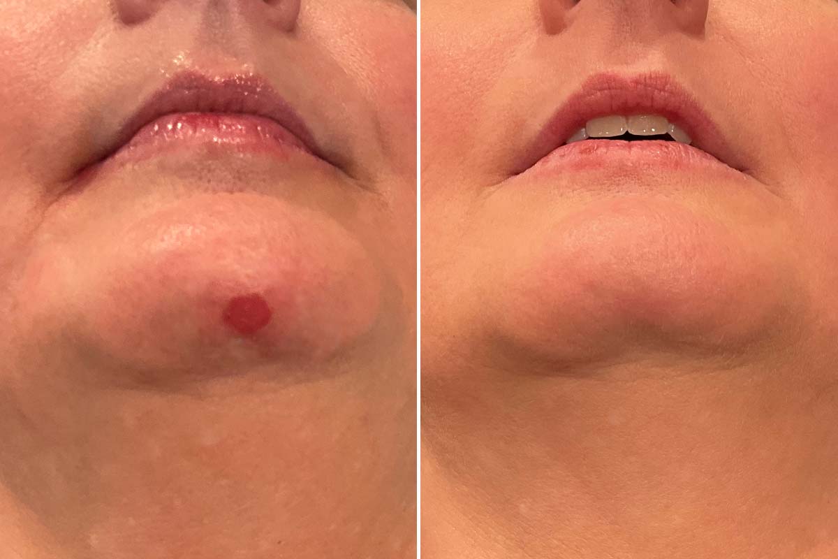 ADVATx laserbehandling