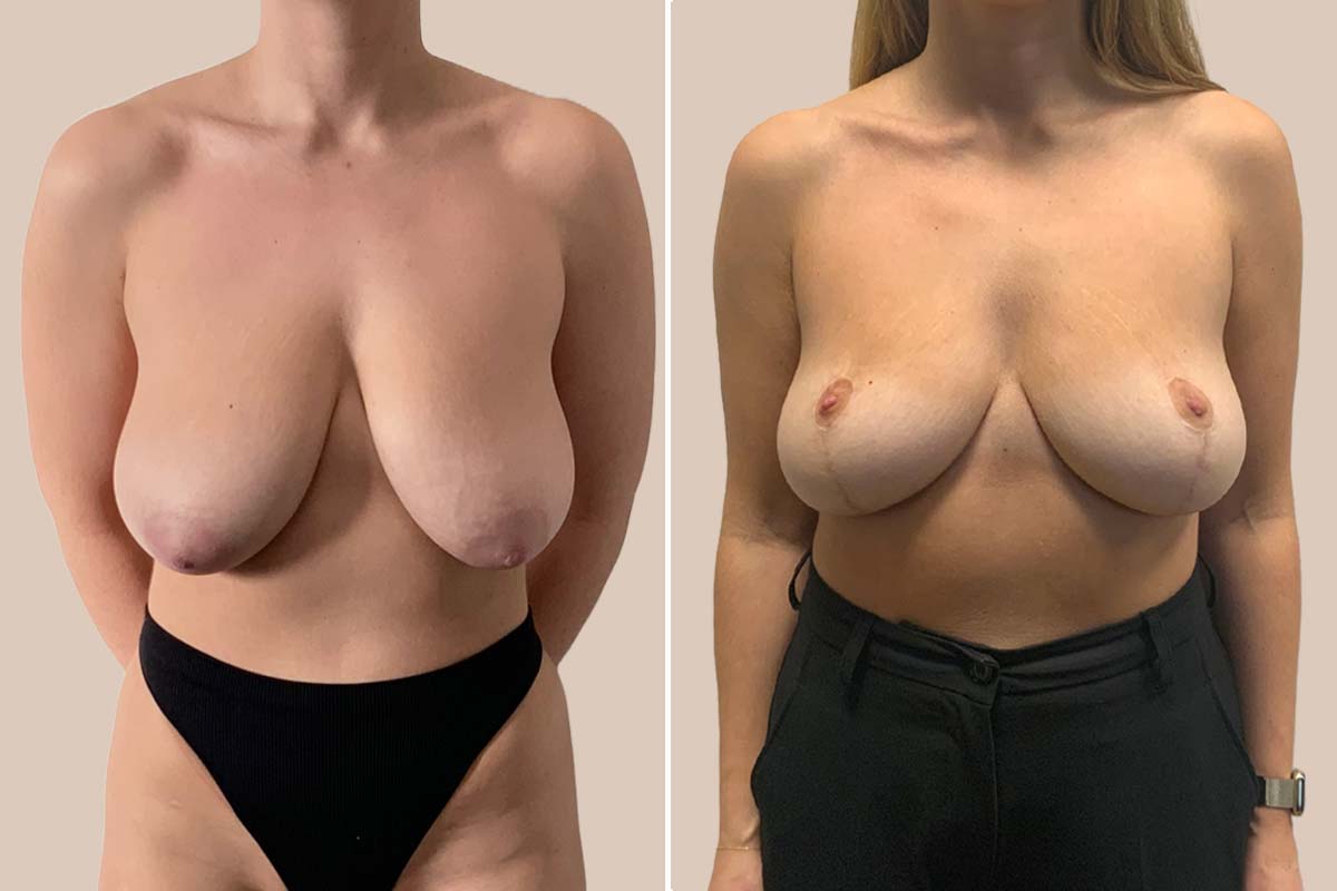 Brystøft før og efter