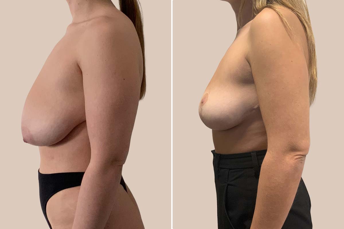 Brystøft før og efter