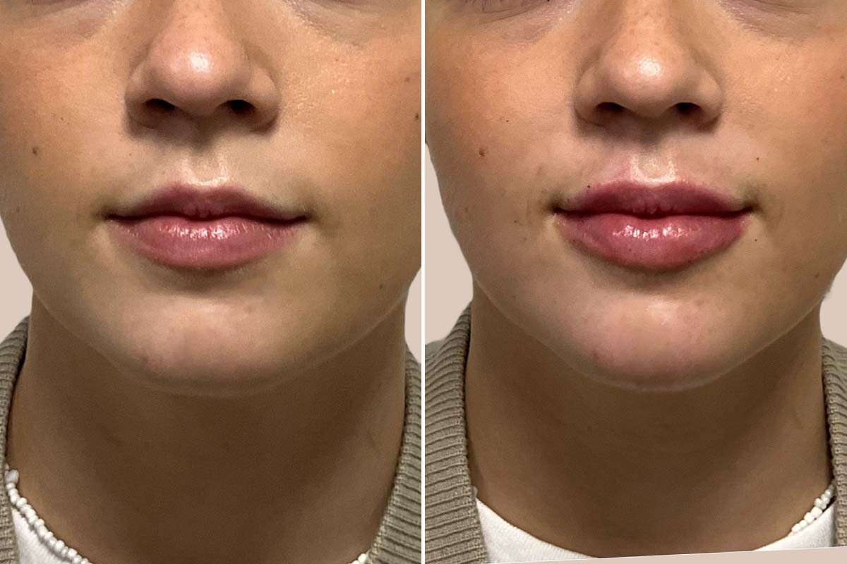 Filler - 1 ml. Restylane Kysse