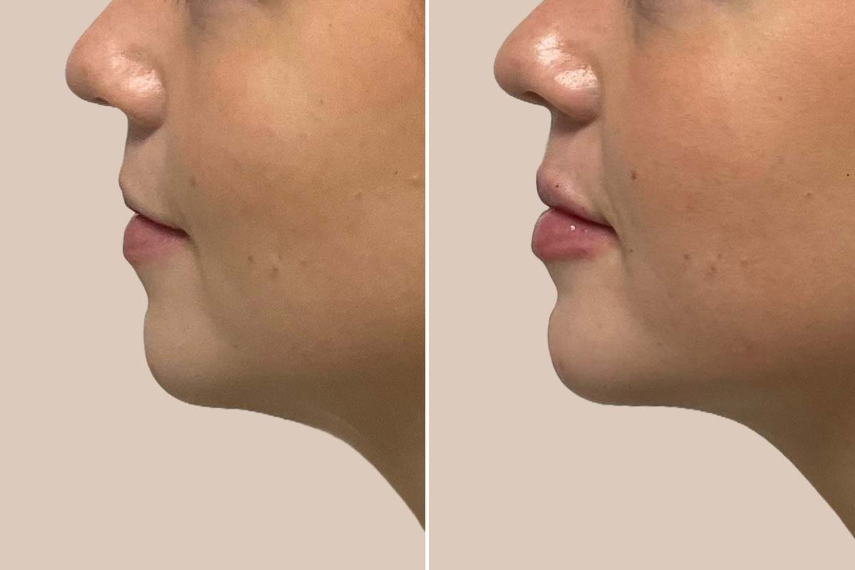 Filler - 1 ml. Restylane Kysse