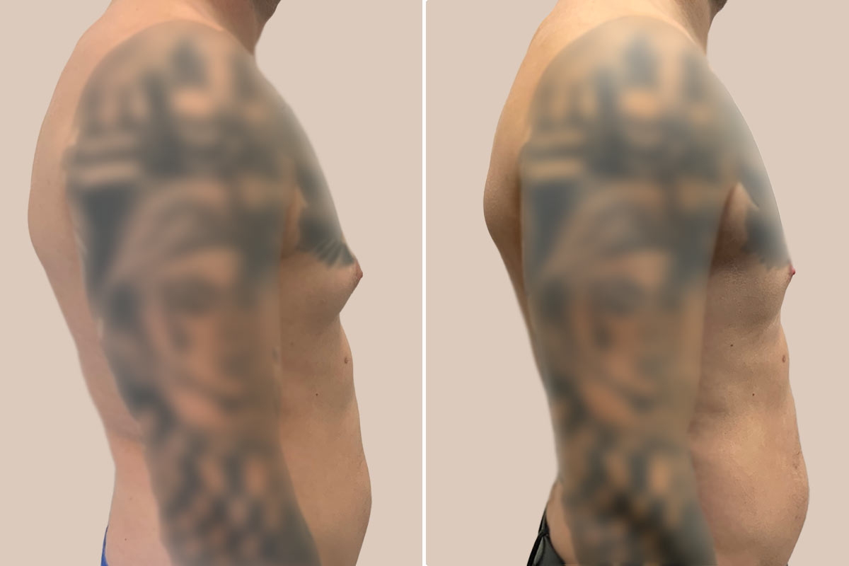 Gynækomasti før og efter