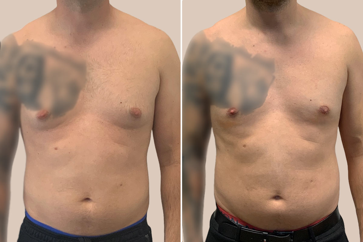 Gynækomasti før og efter