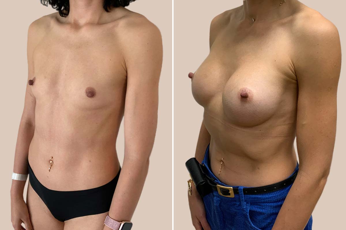 BFO før og efter dråbeformede