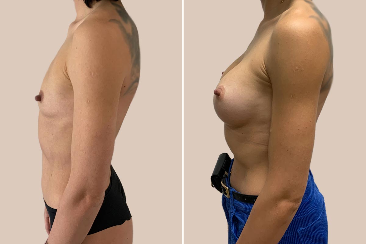 BFO før og efter dråbeformede implantater