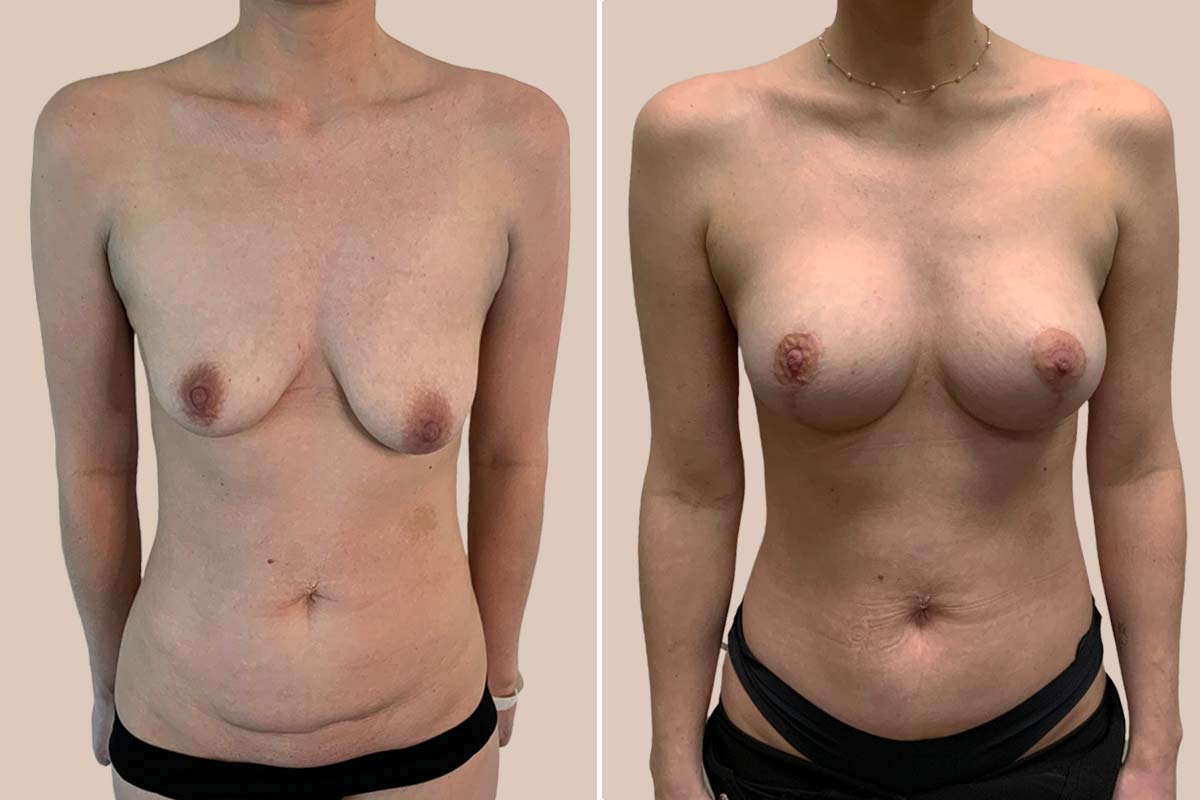 BFO og løft før og efter