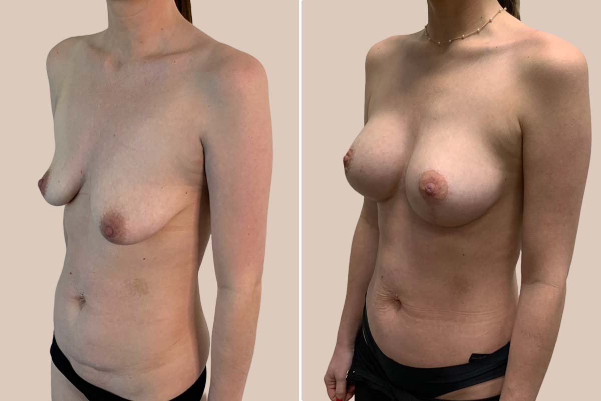 BFO og løft før og efter