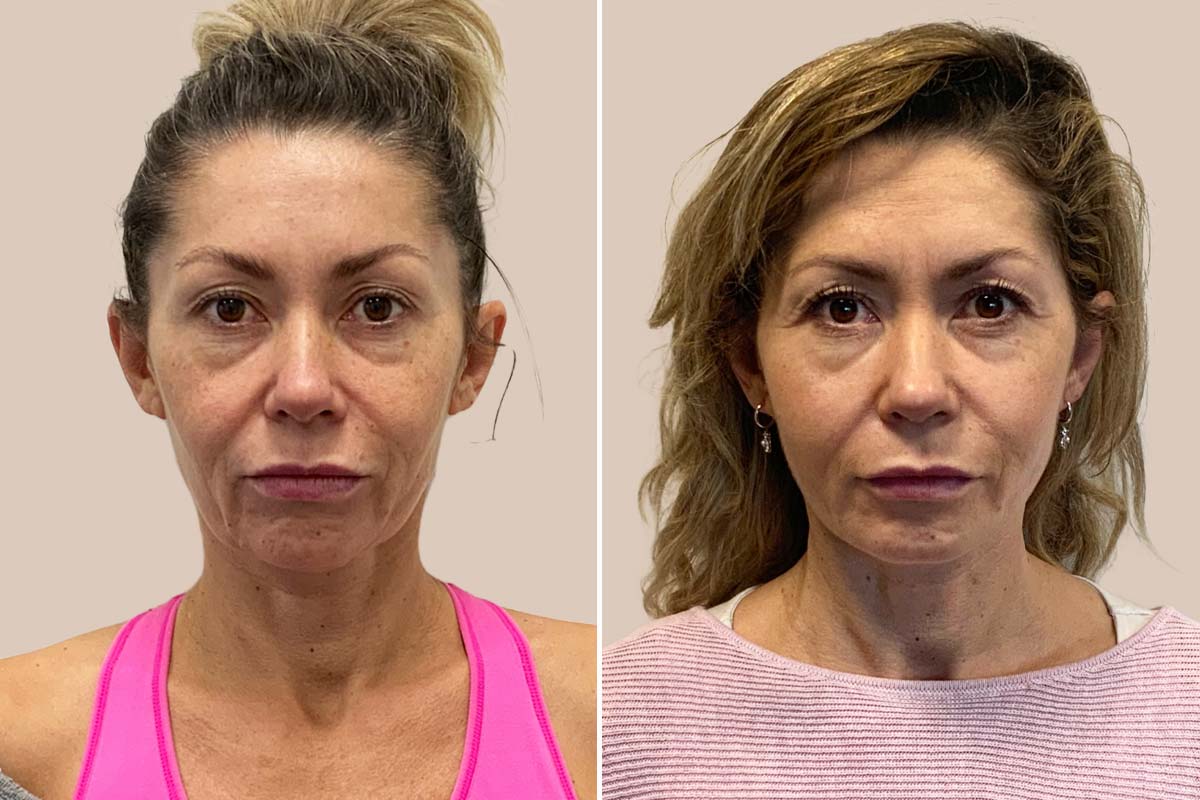 Før og efter mini ansigtsløft