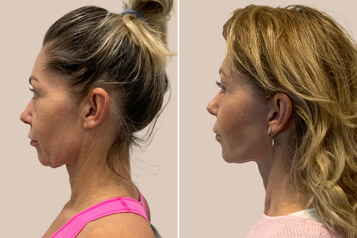Før og efter mini ansigtsløft