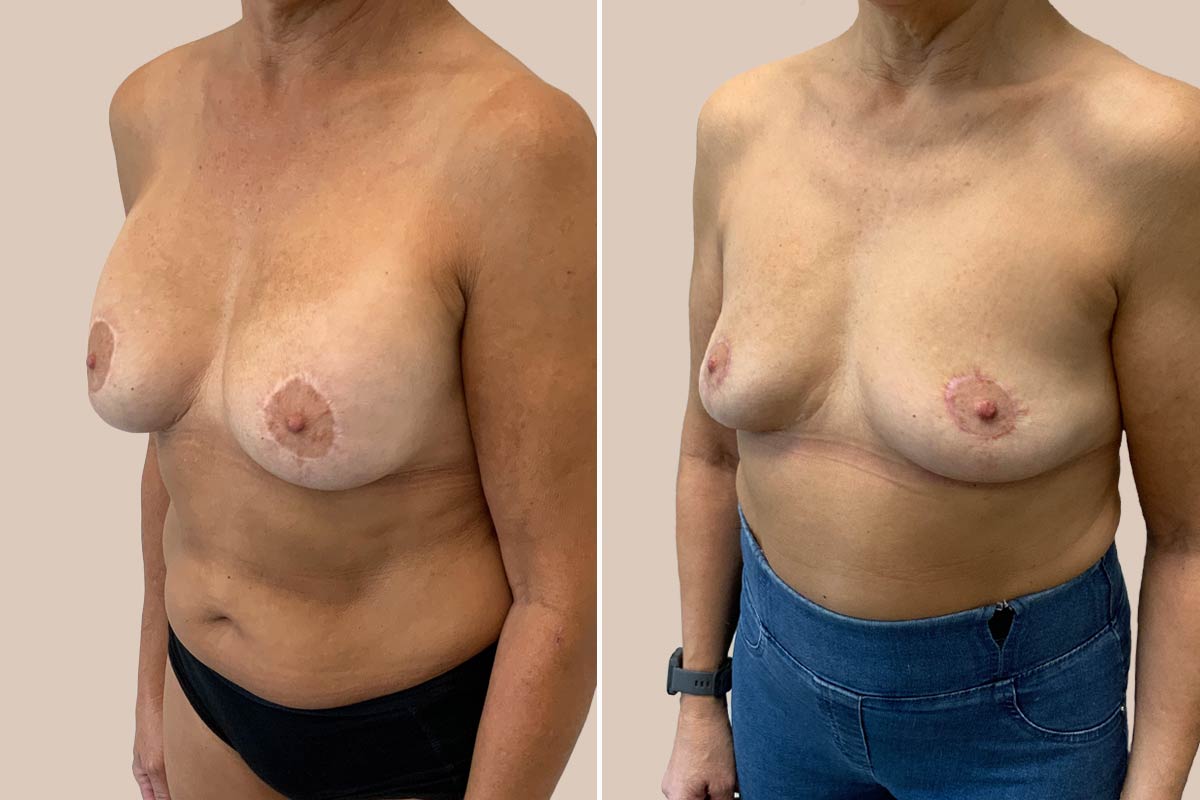 Fjernelse af implantater før og efter