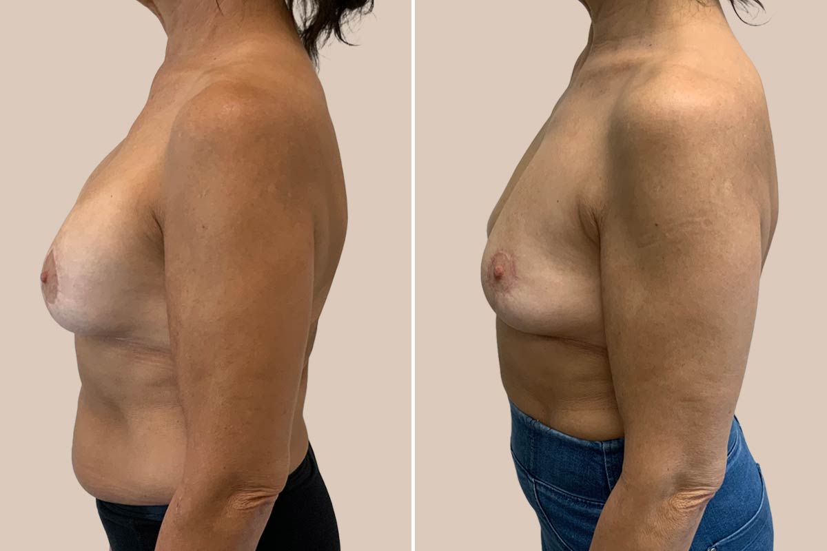 Fjernelse af implantater før og efter