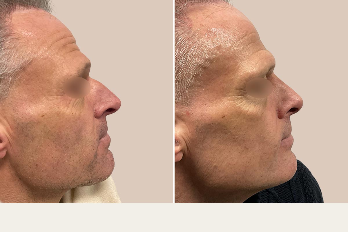 Kosmetisk næseoperation før og efter