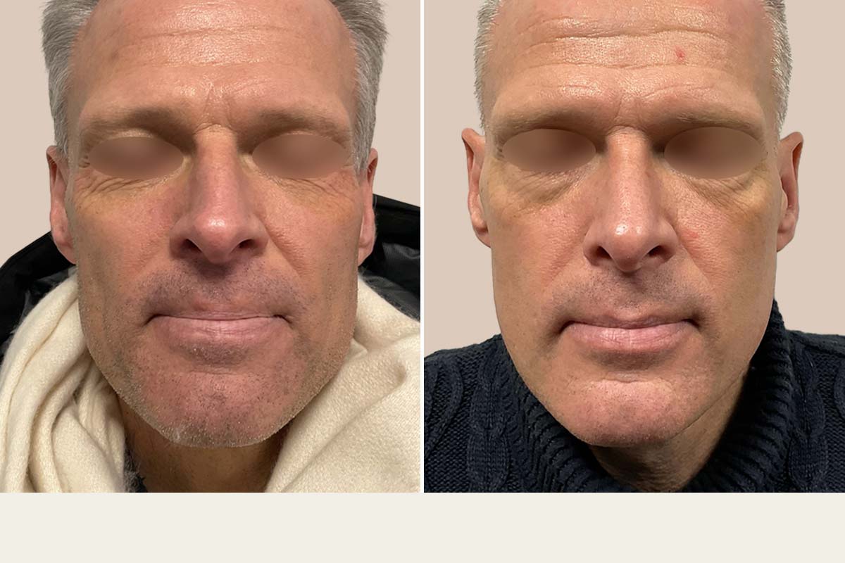 Kosmetisk næseoperation før og efter