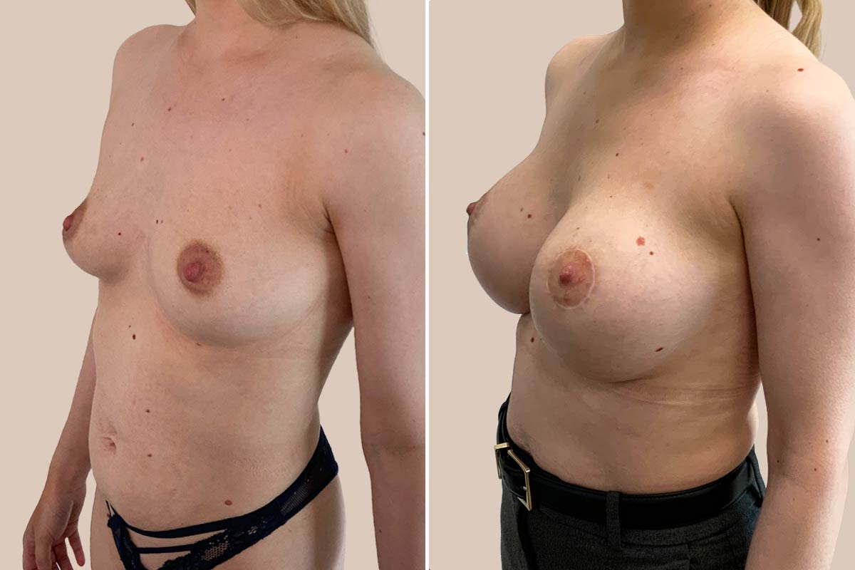 BFO og løft før og efter