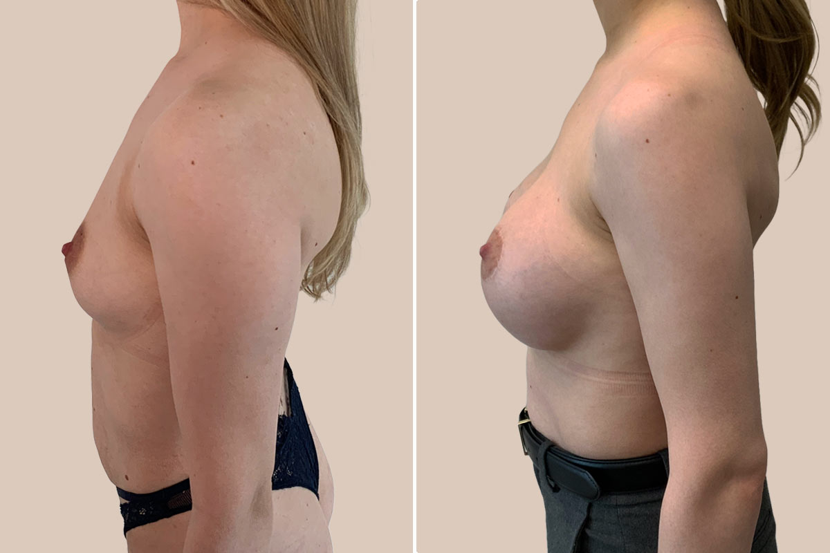 BFO og løft før og efter