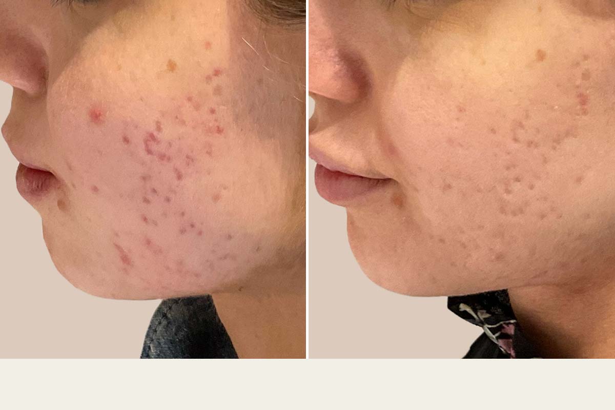 ADVATx laserbehandling af acne ar
