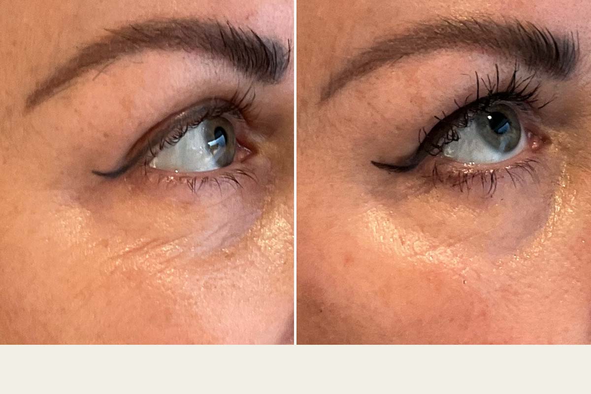 ADVATx laserbehandling af øjenomgivelserne