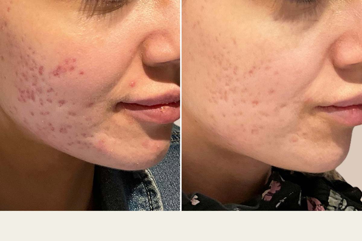 ADVATx laserbehandling af acne ar