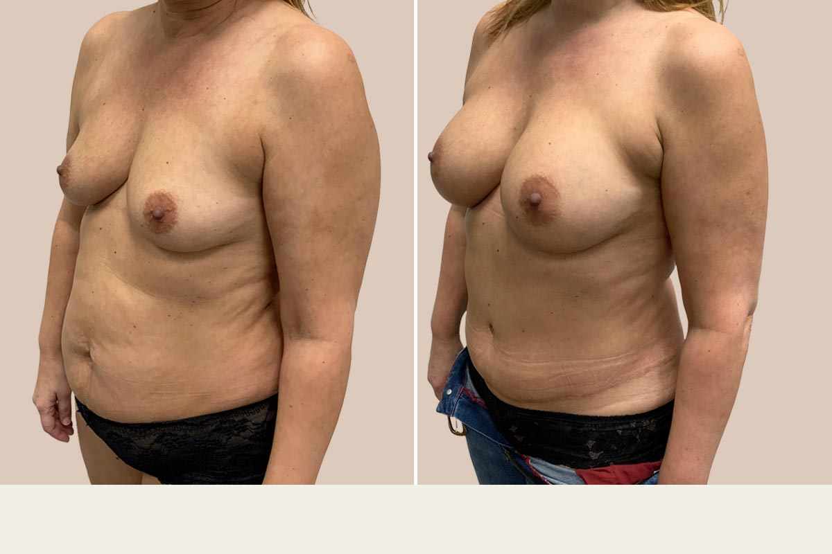 Mommy makeover før og efter