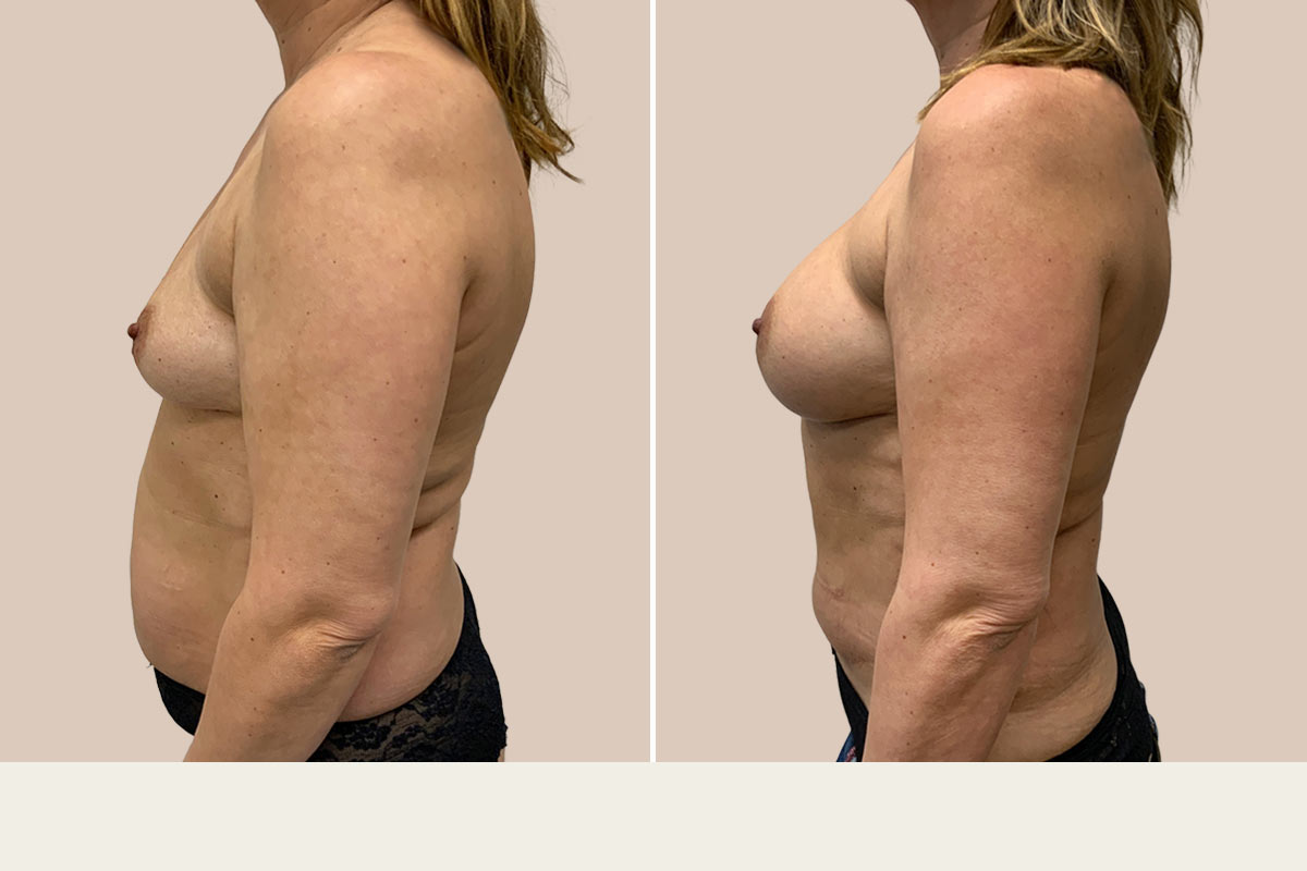 Mommy makeover før og efter