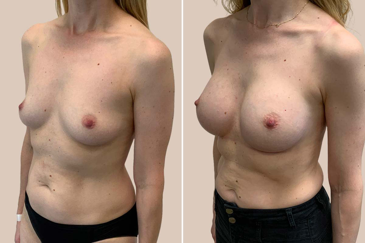 Motiva Ergonomix 2 før og efter