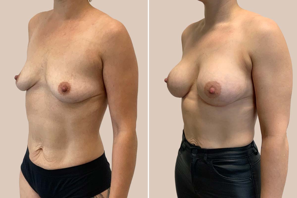 Brystforstørrelse før og efter