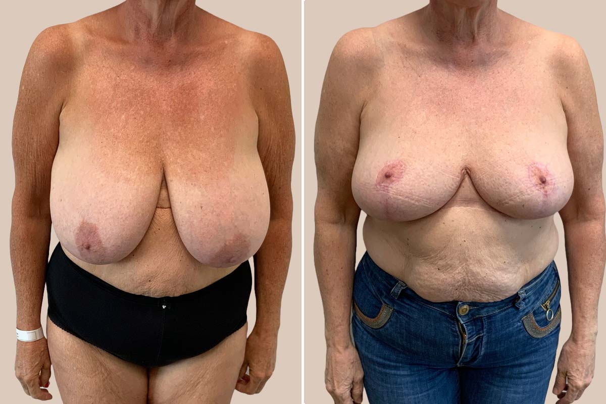 Før og efter brystreduktion