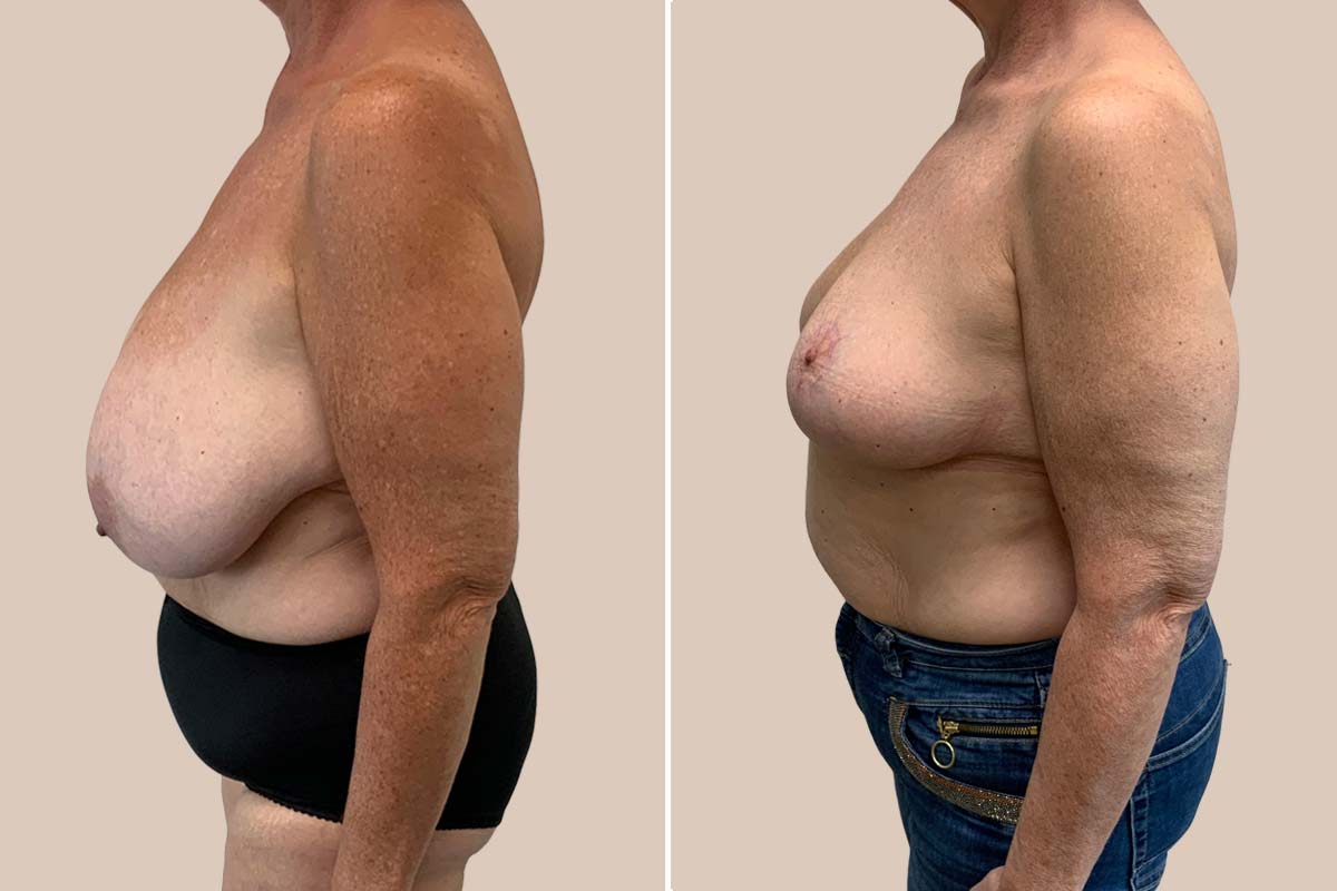 Før og efter brystreduktion