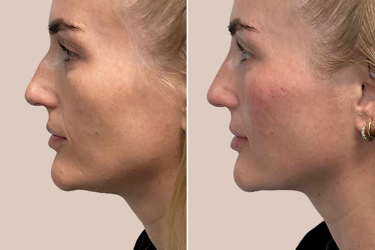 Filler i næsen før og efter