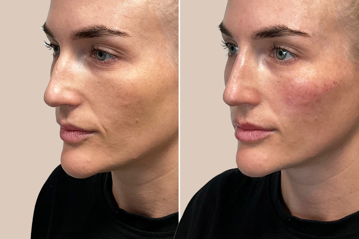 Filler i næsen før og efter