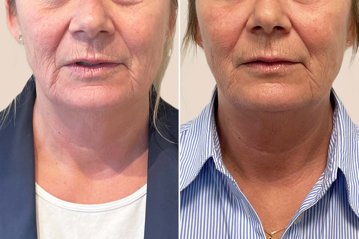 Filler før og efter