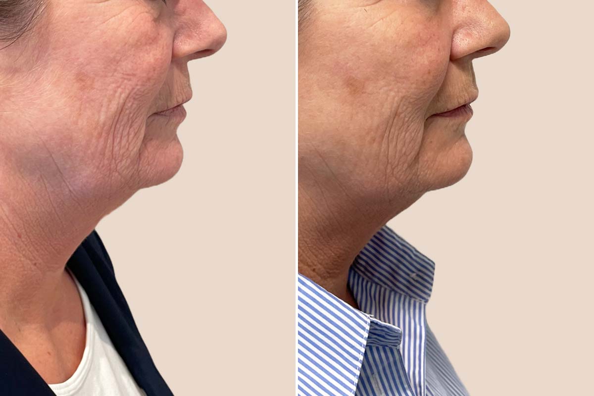 Filler før og efter